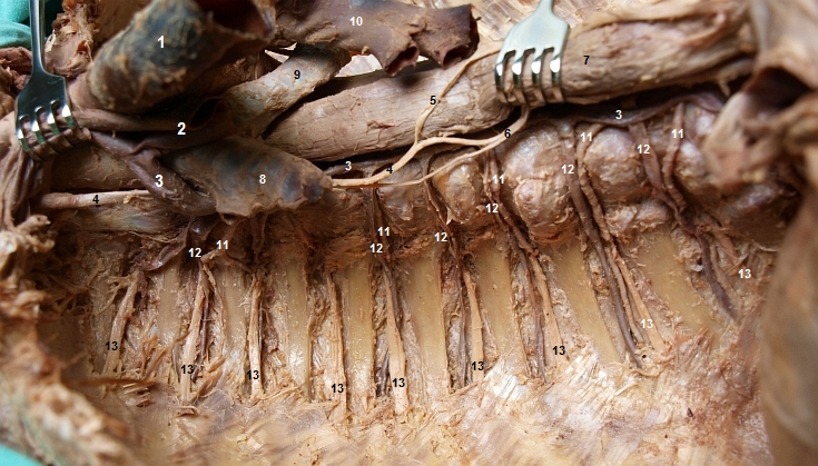Orgny zadnho mezihrud (zprava) (truncus sympathicus odstrann)