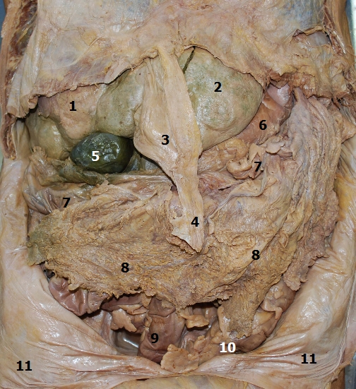 Pehled orgn v bin dutin po odkryt bin stny s peritoneem