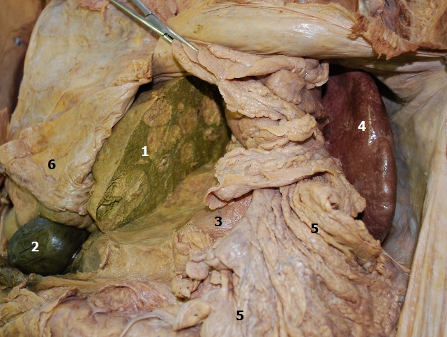 Supramezokolick st peritoneln dutiny (pohled zleva)