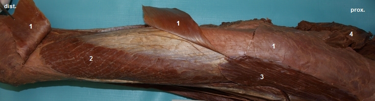 Laterln stranu stehna (odklopena fascia lata femoris)