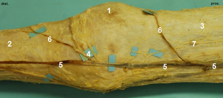 Povrchov tvary na mediln stran kolena