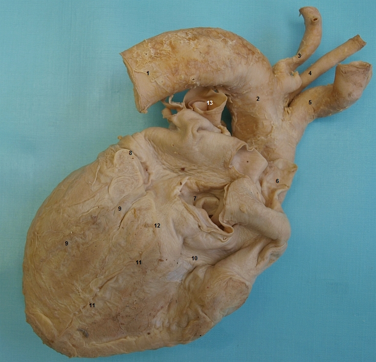 Celkov pohled na srdce a vtve oblouku aorty (zezadu)